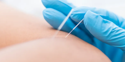 2.Dry Needling
